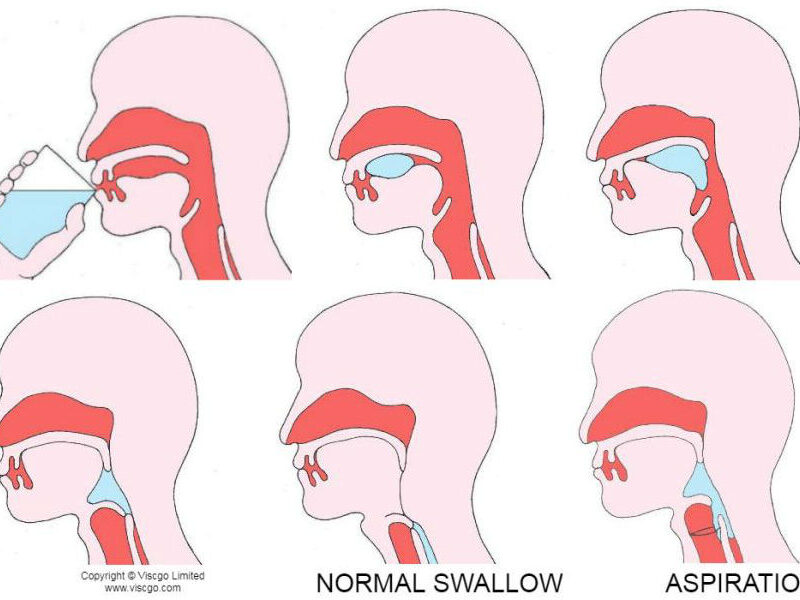 what is dysphagia