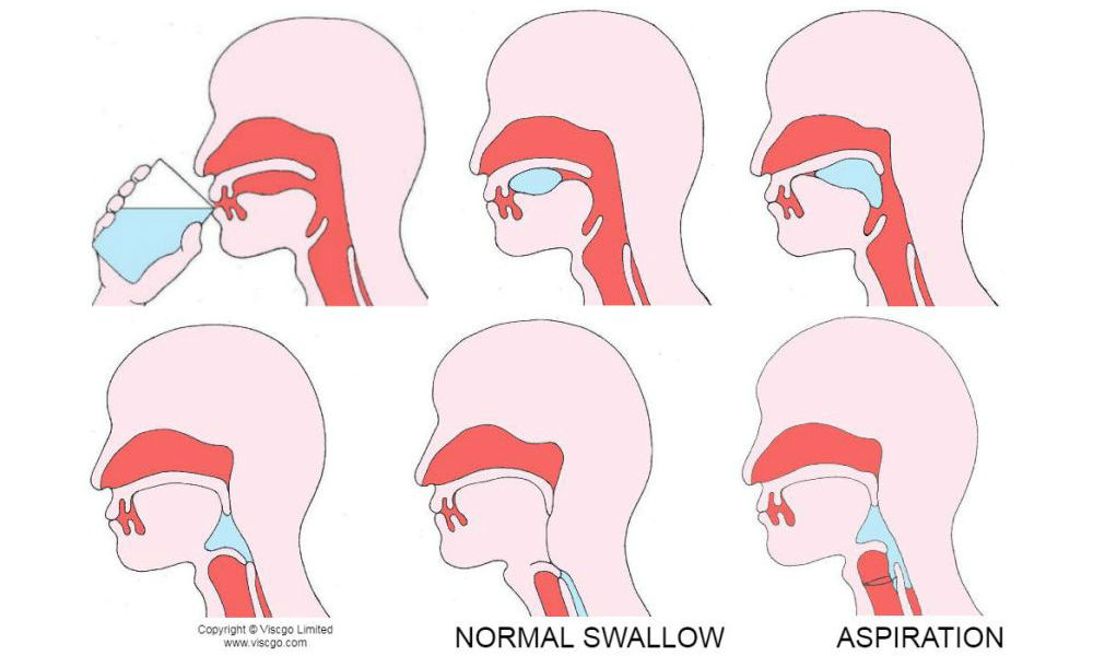 dysphagia stroke